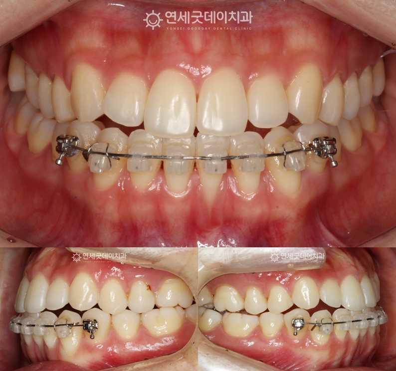 잇몸이식 및 엠도게인 전 아랫니부분교정을 진행 중인 중간모습