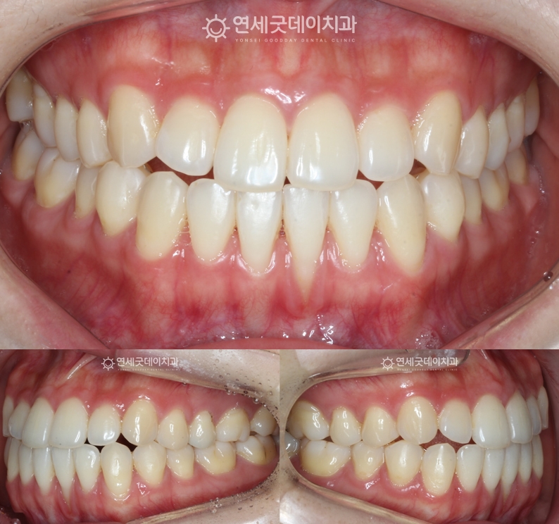 아랫니부분교정을 마친 후 잇몸이 살짝 올라온 모습이며 잇몸이식과 엠도게인 치료 전