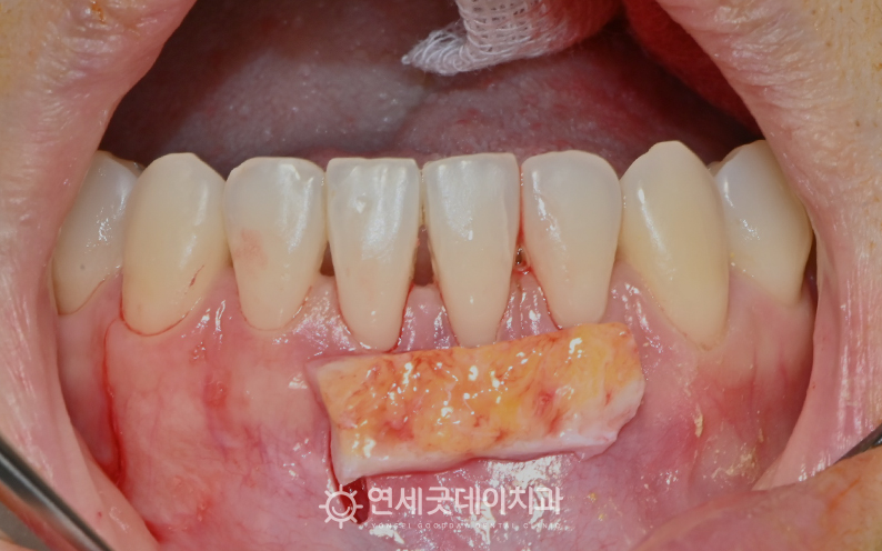 잇몸이식 및 엠도게인 치료과정