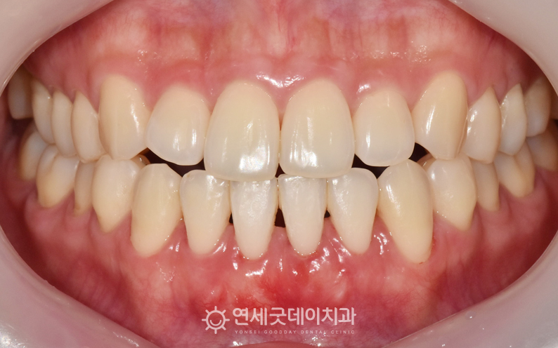 아랫니부분교정 후 잇몸이식과 엠도게인으로 잇몸이 두툼해진 모습
