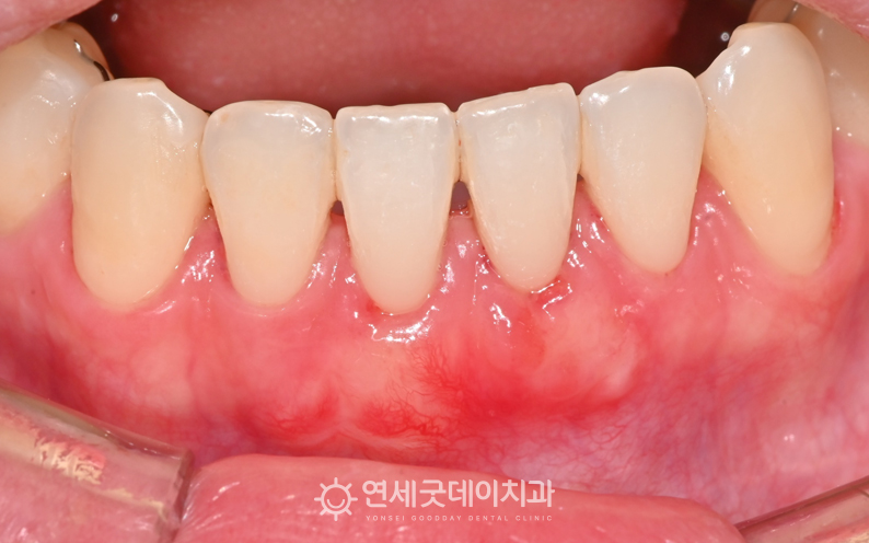 내려간 잇몸이 정상적인 잇몸형태로 개선되었음