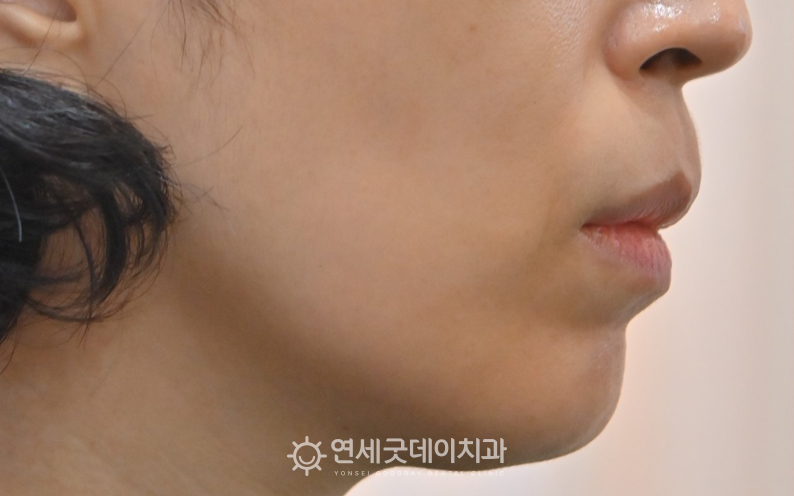 잇몸뼈돌출로 치조골성형을 통한 잇몸돌출교정 희망하심 (잇몸돌출수술 전 모습)