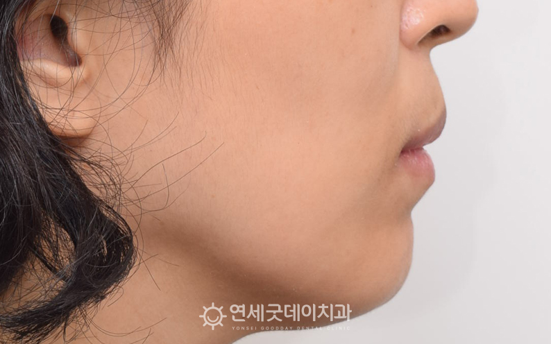치조골성형 후 잇몸돌출교정 된 모습, 잇몸돌출수술 약 10일 후