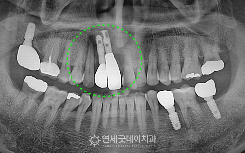 앞니 임플란트 재수술 치료 전 엑스레이 사진