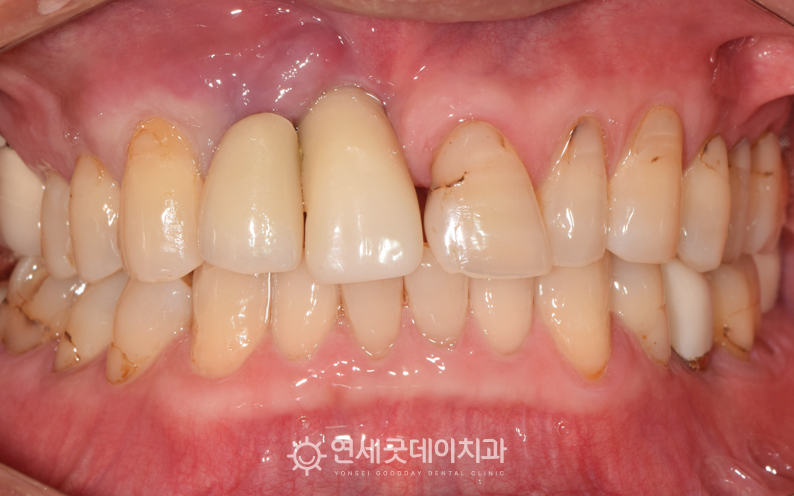 앞니 임플란트 재수술 전 구내 모습이며 잇몸 염증이 심하고 임플란트 모양의 이상이 관찰됨