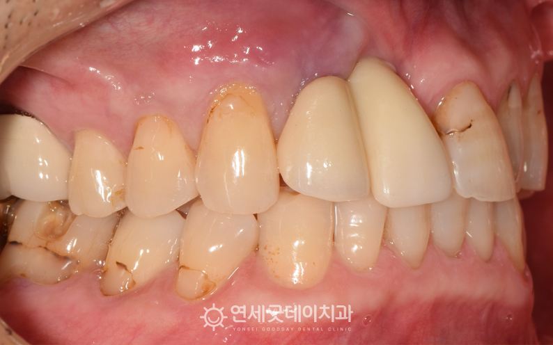 앞니 임플란트 재수술 전 측면 모습