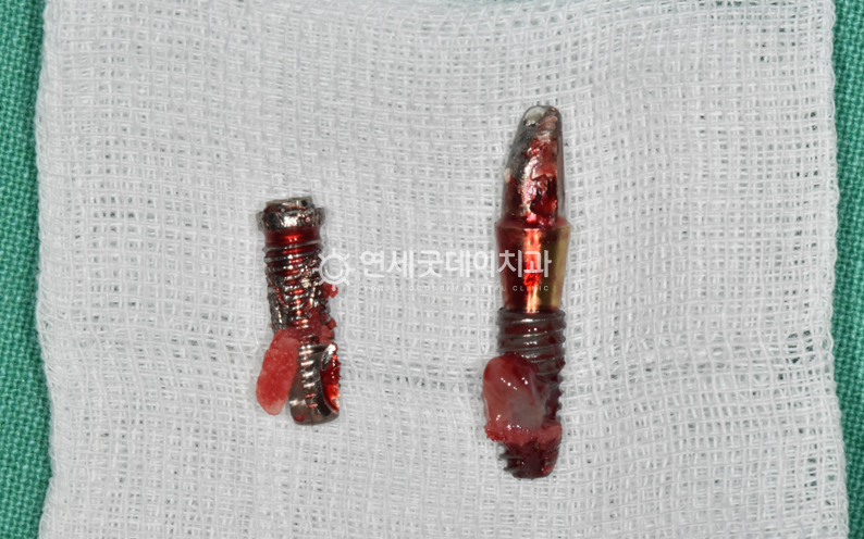 앞니 임플란트 재수술을 위해 제거한 타원 임플란트