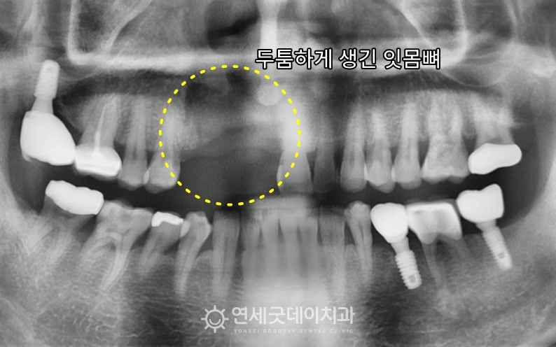 앞니 임플란트 재수술 1단계 - 급속골이식 후 두꺼워진 잇몸뼈