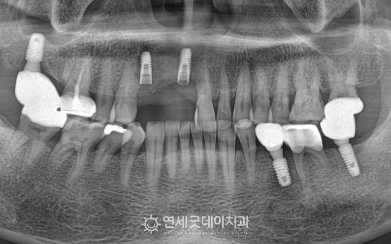 앞니 임플란트 재수술 2단계 - 두꺼워진 잇몸뼈에 임플란트 식립
