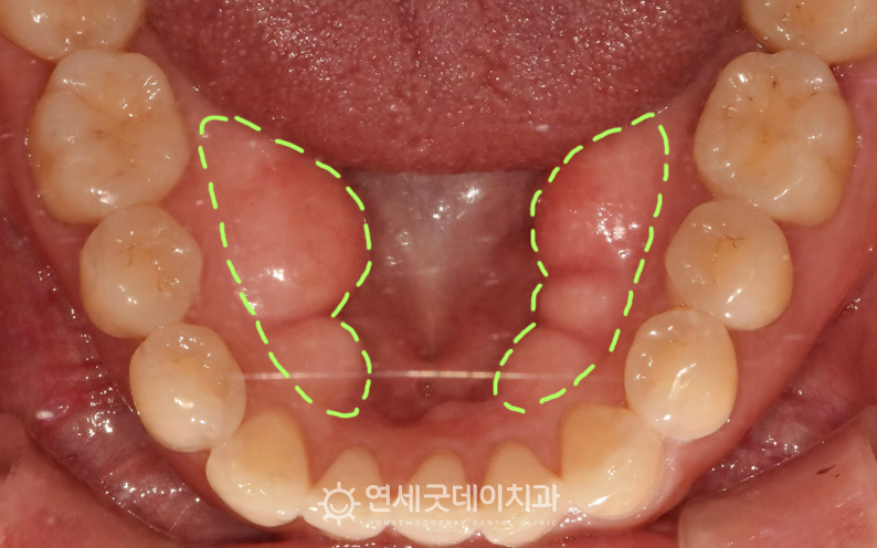 치조골성형술 전 입안에 혹 처럼 하악골융기가 생긴 모습