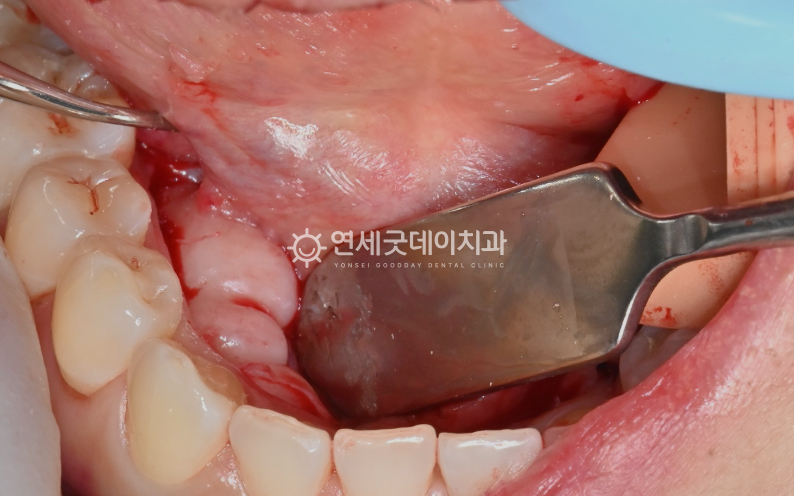 치조골성형 진행 중인 모습이며 잇몸을 열어 하악골융기를 제거함