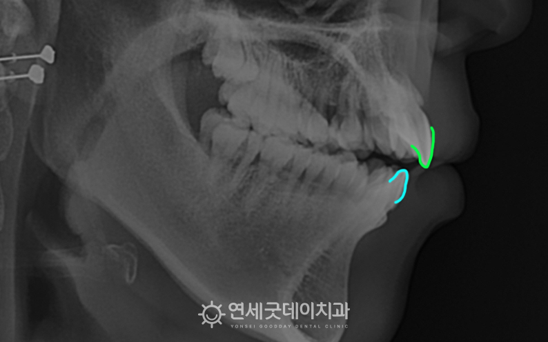 턱관절교정 및 개방교합교정을 위해 내원하여 찍은 엑스레이 사진입니다