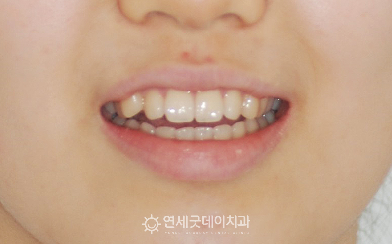 턱관절교정 전 퇴행성관절염으로 인해 개방교합 교정이 필요한 상태