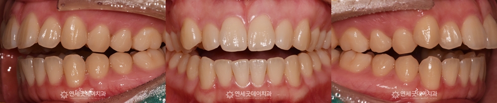 턱관절교정(개방교합교정) 전 구내 모습