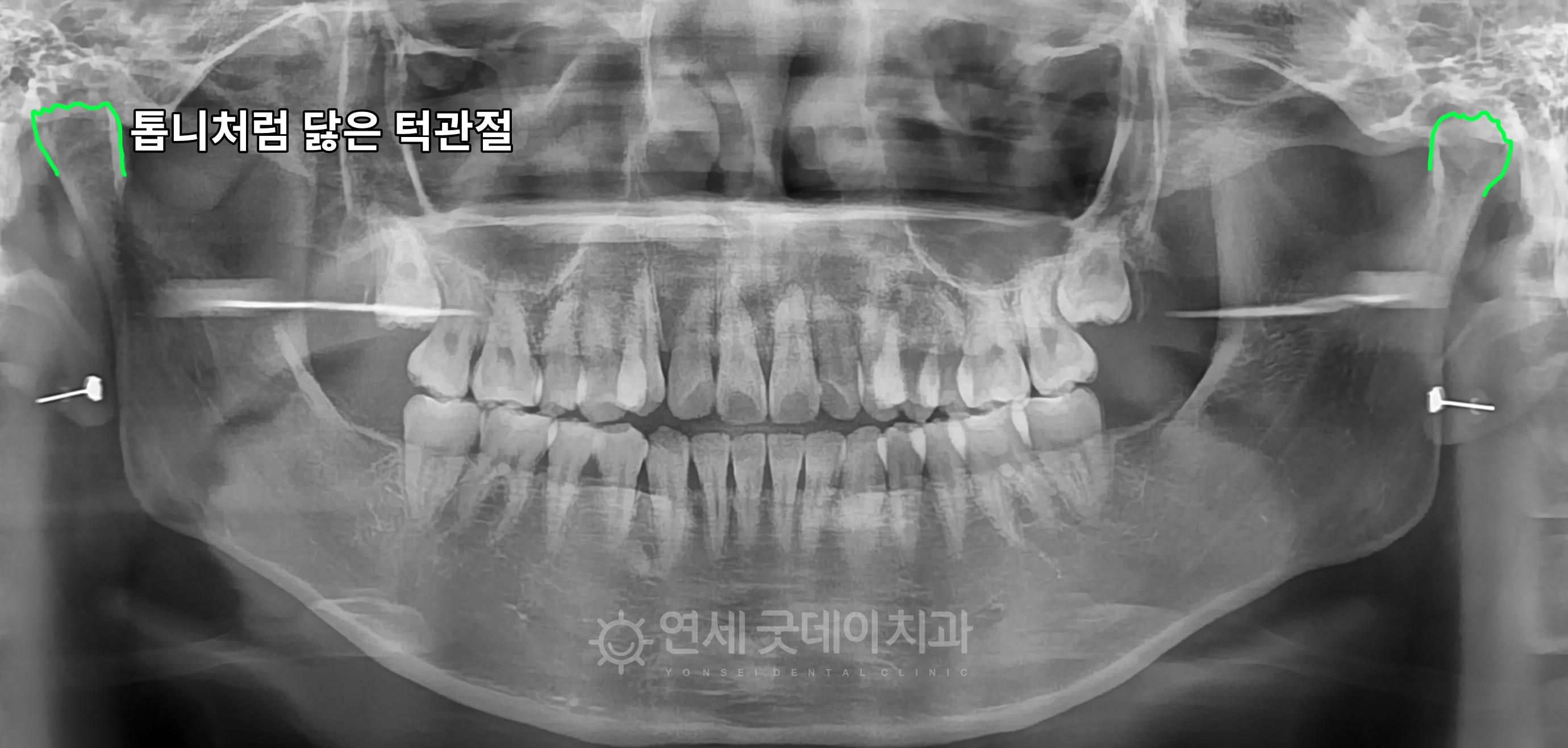턱관절 퇴행성관절염으로 인해 톱니처럼 닳아진 턱관절