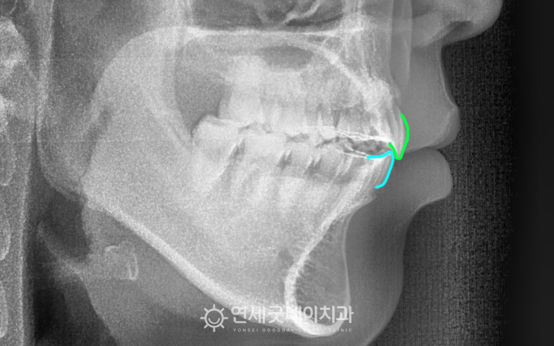 턱관절교정, 개방교합교정 완료 후 엑스레이이며 윗니가 아랫니를 덮는 정상교합으로 개선됨