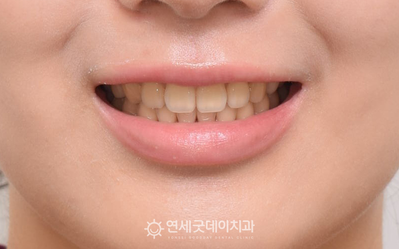 개방교합교정 이후 윗니가 아랫니를 2~3mm가량 덮는 정상교합이 되었음