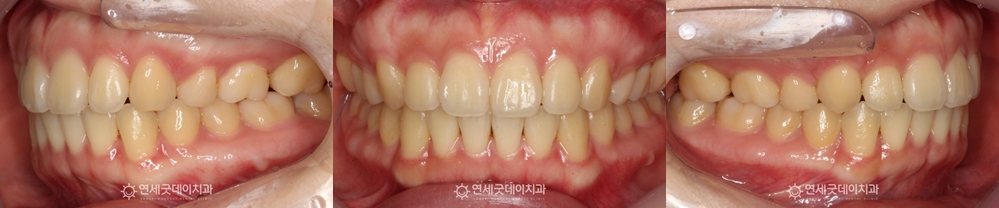 턱관절교정 완료 후 구내모습