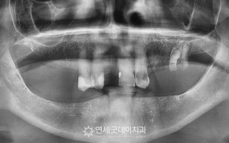 무치악 노인임플란트틀니 치료전 엑스레이 촬영본