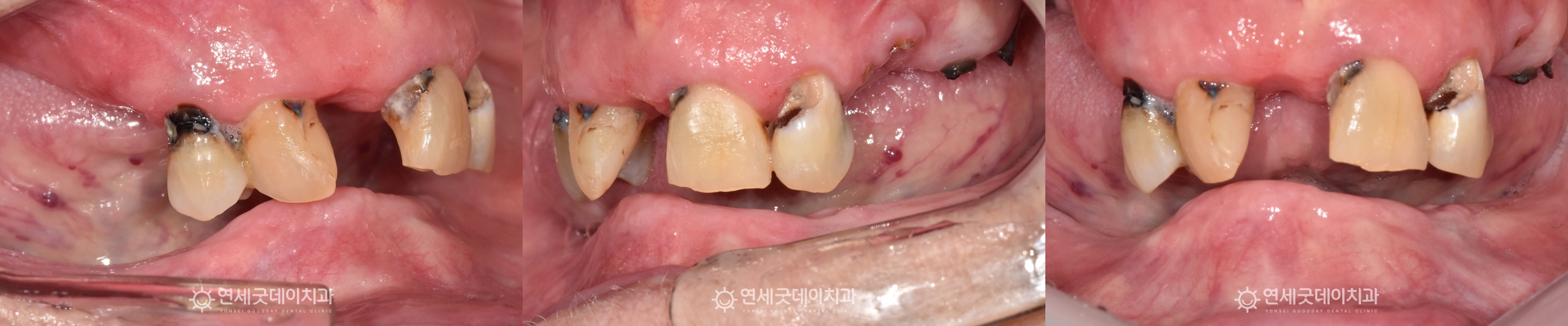 무치악 노인임플란트틀니 전 구내 모습 측면 정면
