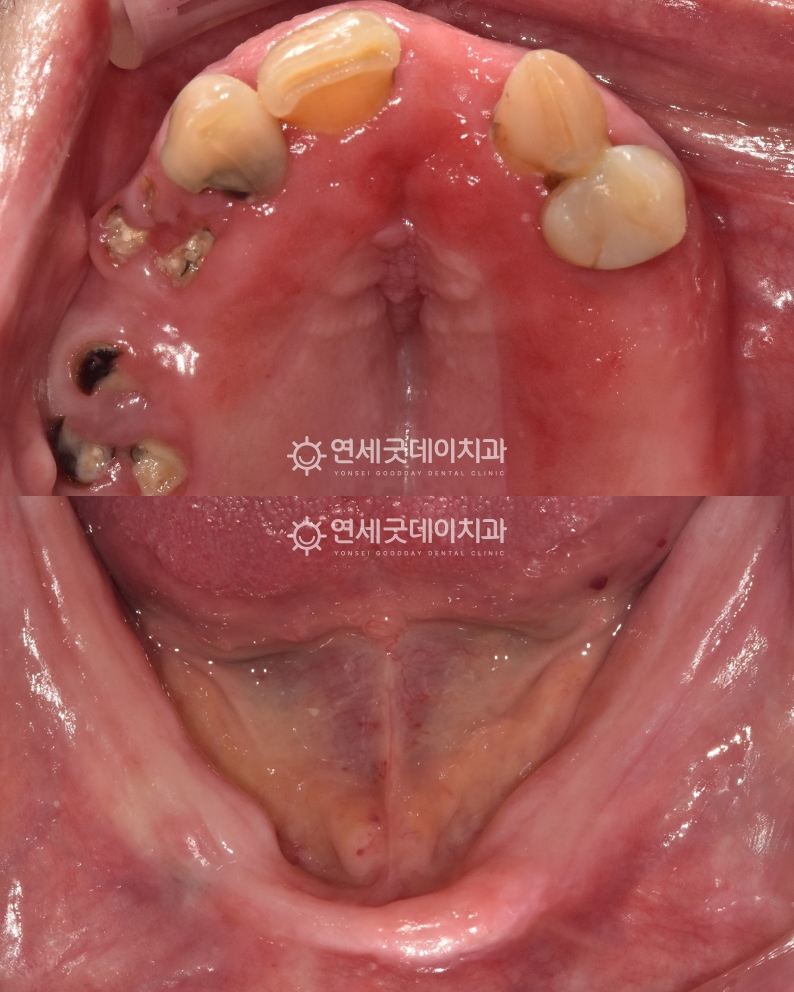 무치악 노인임플란트틀니 치료전 상악과 하악 구내모습