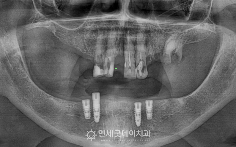 노인임플란트틀니 치료를 위한 하악 임플란트 식립 모습