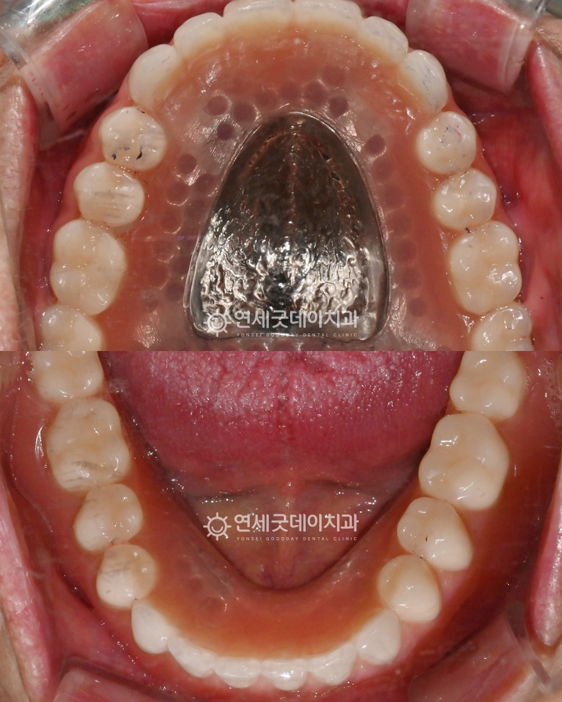 노인임플란트틀니 치료완료 후 구내모습이며 상악은 전체틀니 하악은 임플란트틀니를 진행하였음