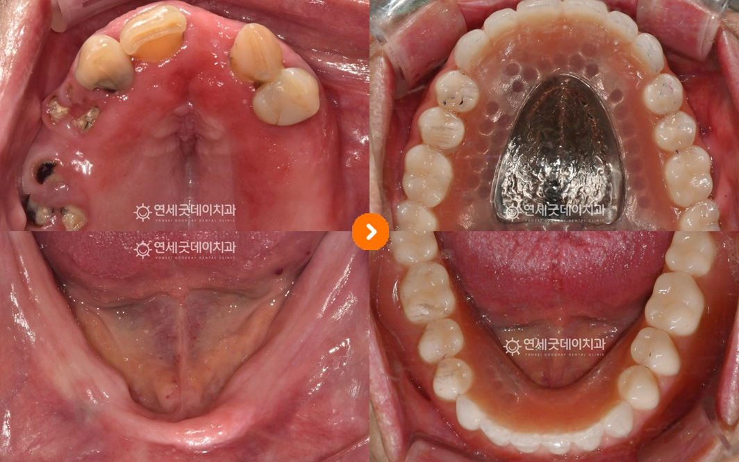 무치악 노인임플란트틀니 치료 구내 상하악 비교