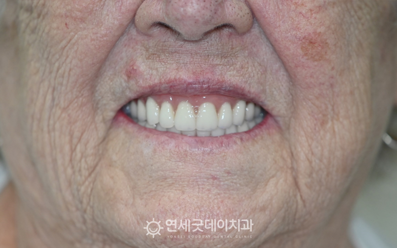 노인임플란트틀니 후 환하게 웃는 환자분의 모습