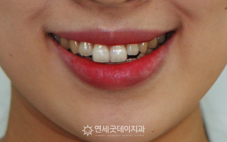 치아중심선의 비대칭으로 안면비대칭 발생