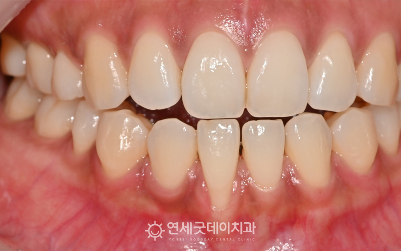 아래 앞니 잇몸이 내려가 핀홀수술과 잇몸이식 진행하기로 하였음