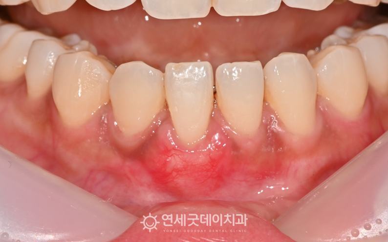 핀홀수술 및 잇몸이식 후 약 한달 경과