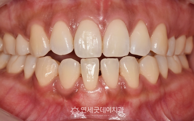 핀홀수술 및 잇몸이식 후 6개월 경과