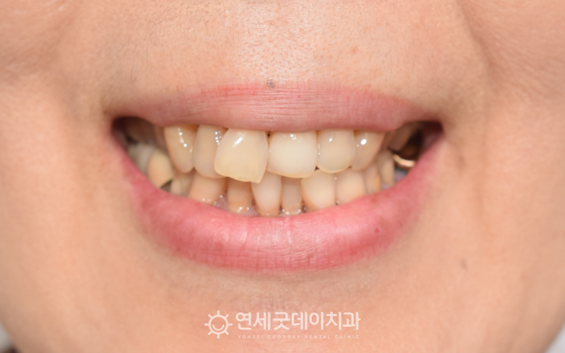 50대치아교정을 희망하여 내원해주셨으며 치료전 안모모습
