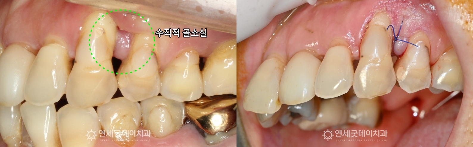 치주교정 전 치주질환 치료를 먼저 진행하였음