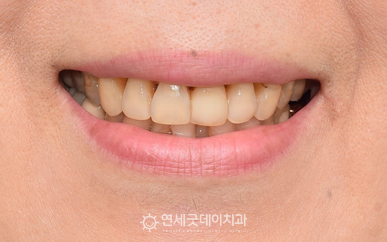 50대 치아교정 (치주교정) 후 안모 모습
