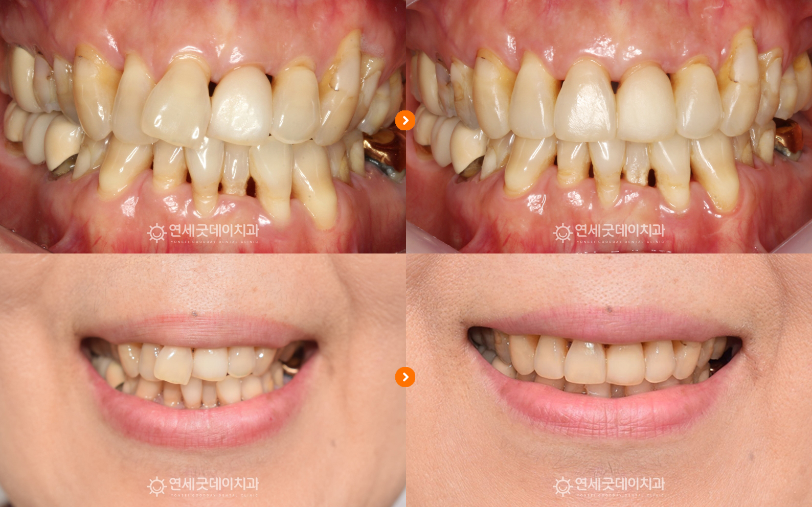 치주교정 치료전후 비교 모습(구내, 안모)