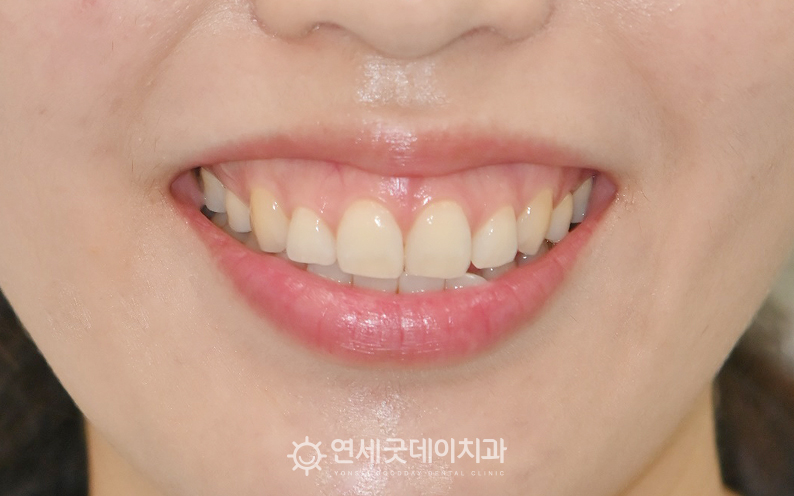 거미잇몸 치료 전 안모 모습이며 잇몸이 많이 드러나는 모습