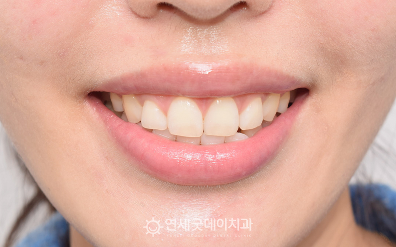 입술재배치술을 통해 거미잇몸이 개선된 안모