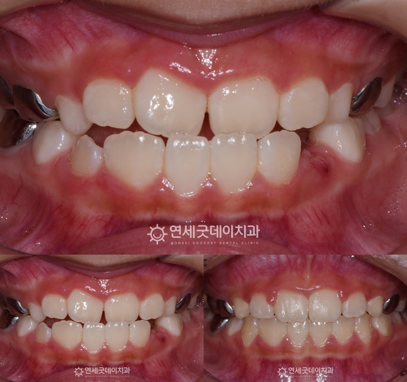 어린이 반대교합을 문제로 내원하였으며 프리올소를 통한 1차교정 치료계획 수립