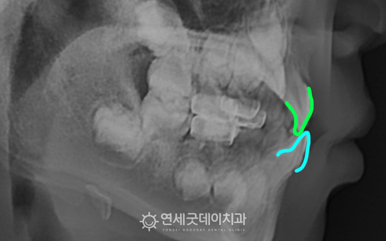 아랫니가 윗니를 덮는 어린이 반대교합 관찰