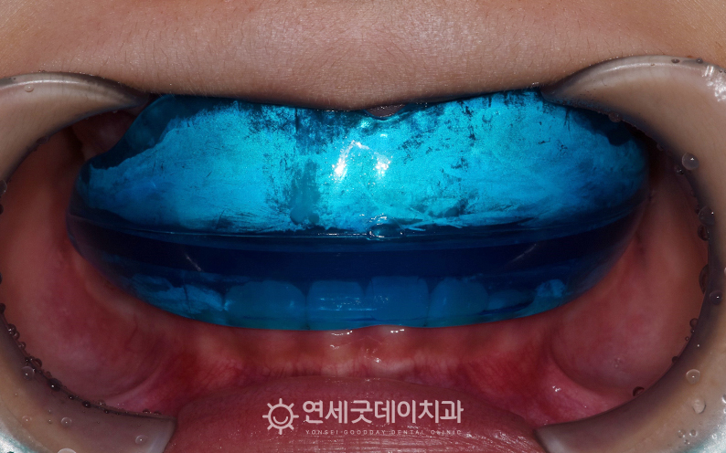 1차교정 장치인 프리올소 착용 모습