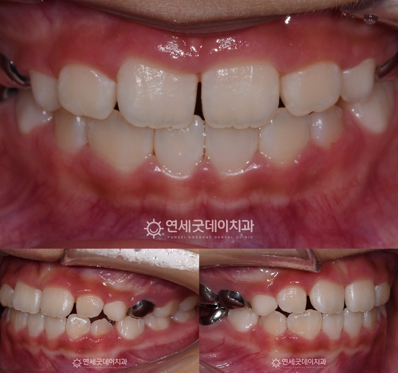 1차교정 프리올소 착용 1개월 지났으며 어린이 반대교합이 눈에 띄게 개선된 모습