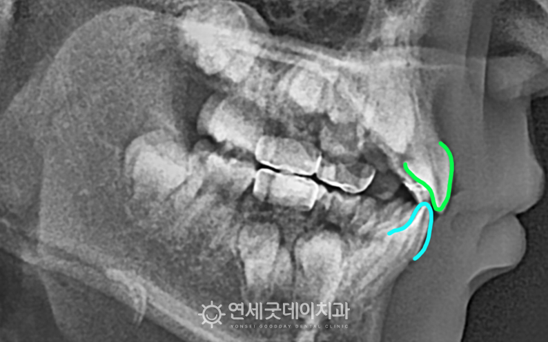 어린이 반대교합에서 1차교정을 통해 윗니가 아랫니를 덮는 정상교합으로 개선됨