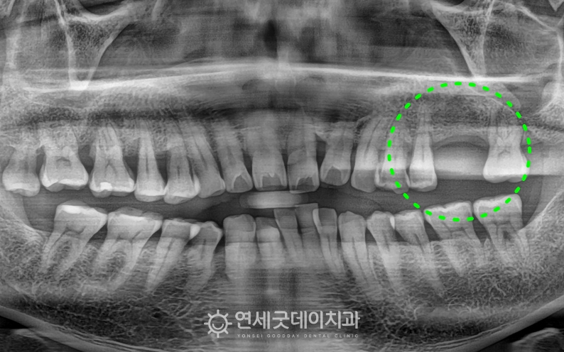 어금니 당일 임플란트 치료전 엑스레이