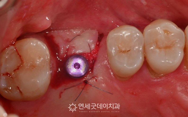 어금니 임플란트 진행 과정 - 취리히 술식을 이용한 당일 임플란트 진행