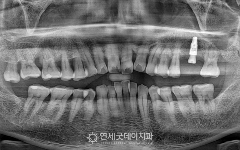 취리히 술식을 이용한 당일 임플란트 후 엑스레이