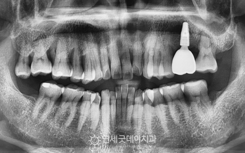 당일 임플란트 후 엑스레이 모습이며, 우수한 고정력을 보임