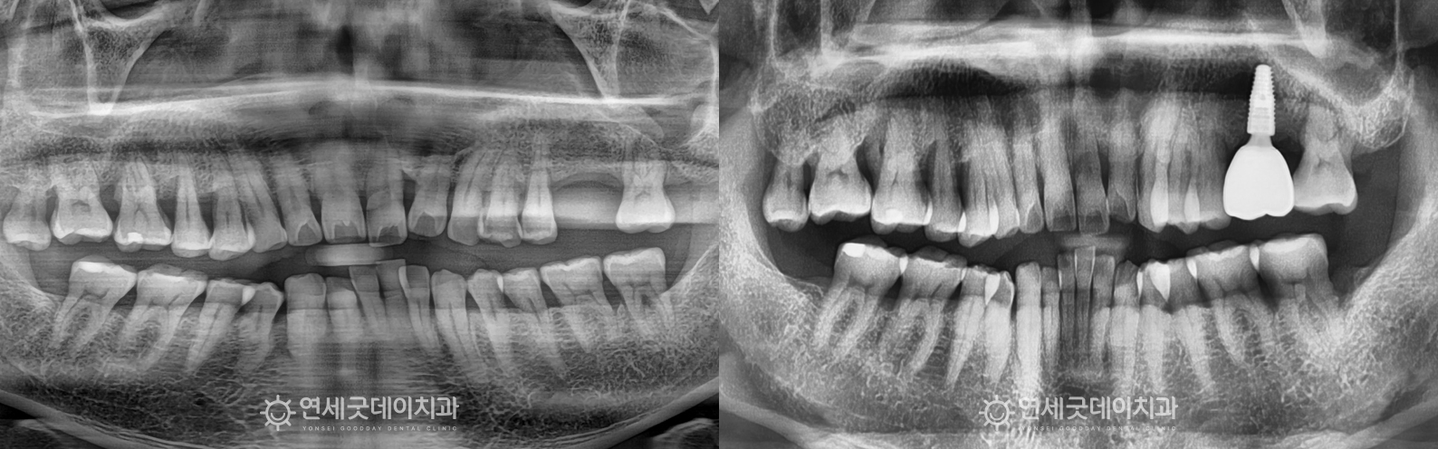어금니 당일 임플란트 치료전후 비교 모습 (x-ray)