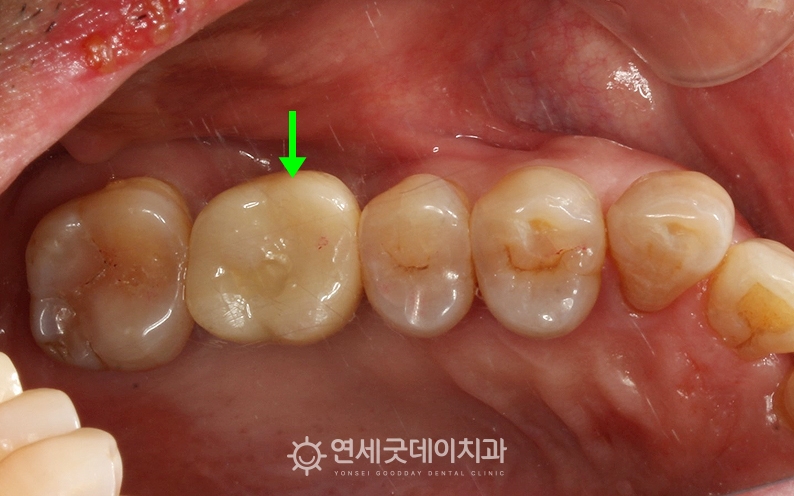 어금니 당일 임플란트 완료 후 구내 모습